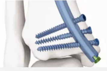 Clavo intramedular tibial distal – fijación retrógrada – imagen 5