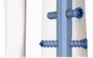 Clavo intramedular tibial distal – fijación retrógrada – imagen 4