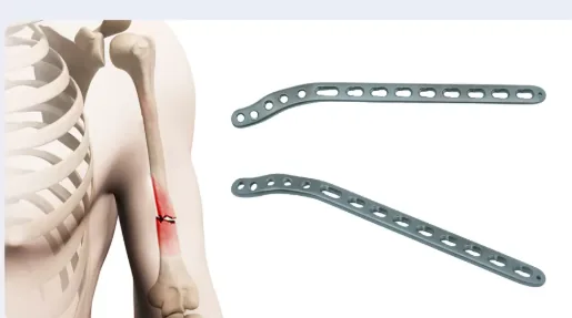 Placa de bloqueo para húmero distal (lateral)