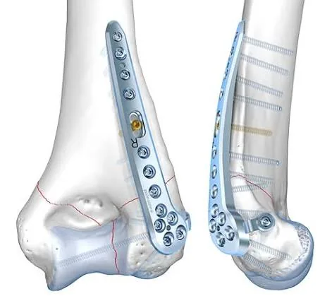 Placas de bloqueo en húmero distal