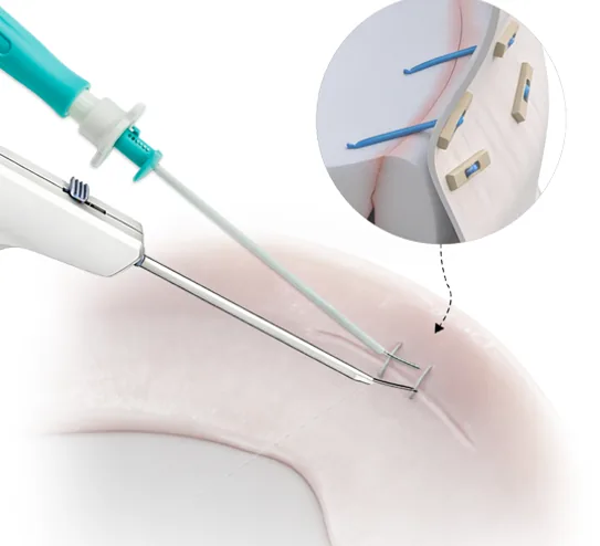 Sistema de reparación meniscal todo-dentro (all-inside)