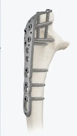Placa de bloqueo de cúbito proximal y olécranon