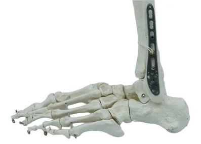 Placa de bloqueo de peroné distal – imagen 9