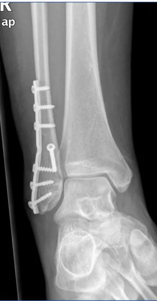 Radiografía con placa de peroné distal